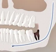 Dry Sockets Demystified: Understanding the Connection to Tooth